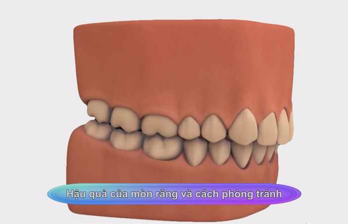 Sống khỏe 360 -  Hậu quả của mòn răng và cách phòng tránh 21-01-2020